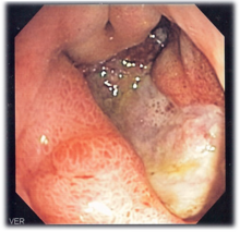 220px-deep_gastric_ulcer